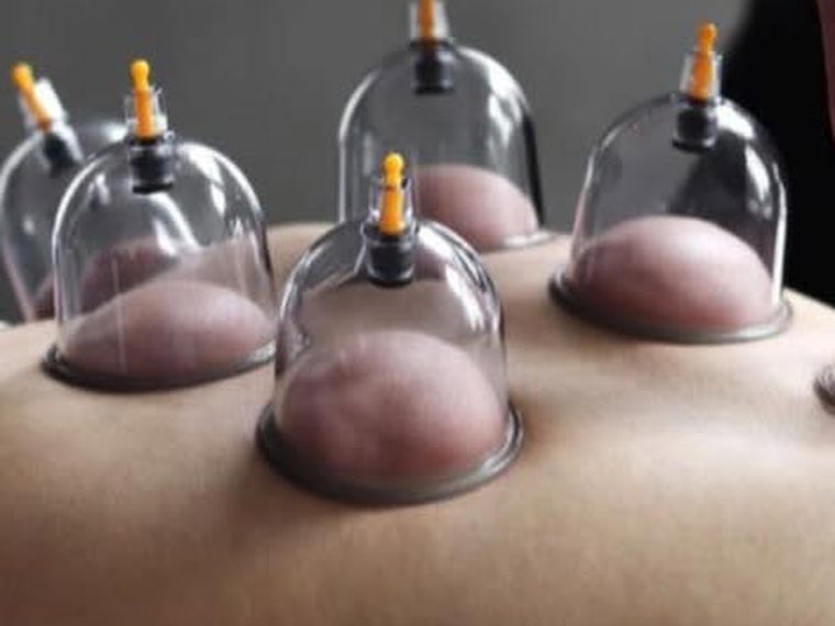 Ventouses de hijama stériles posées sur la peau